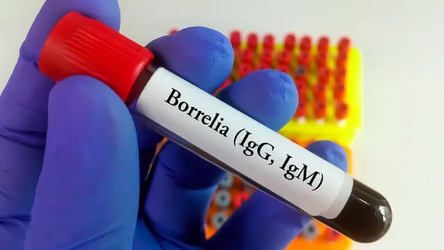 Jakie badania na boreliozę? Kluczowe testy, które musisz znać Jakie badania na boreliozę? Kluczowe testy, które musisz znać